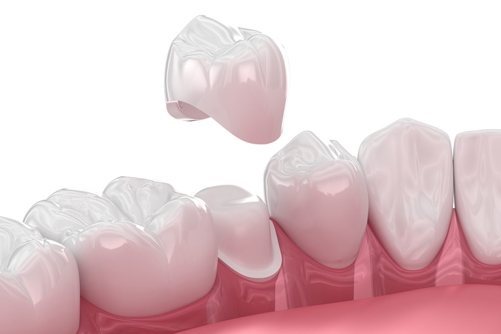 Restoring Your Smile with Dental Crowns at Preston Dental Loft